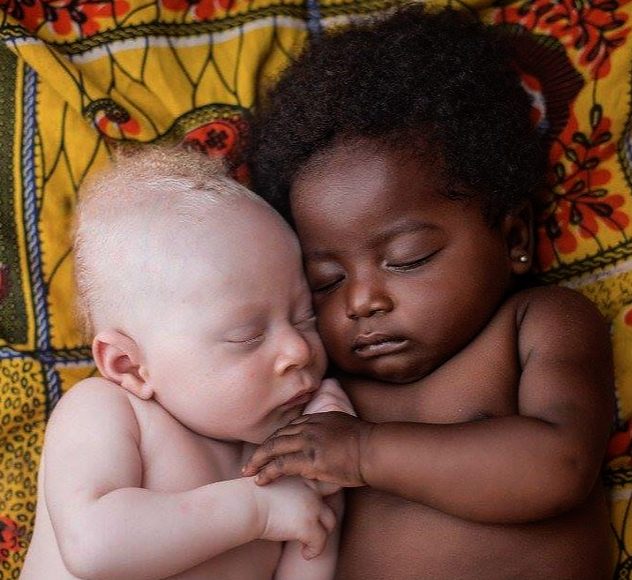 albino african american baby